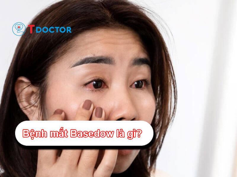 Bệnh Mắt Basedow: Nguyên nhân và cách điều trị bệnh Bệnh Mắt Basedow: Nguyên nhân và cách điều trị bệnh