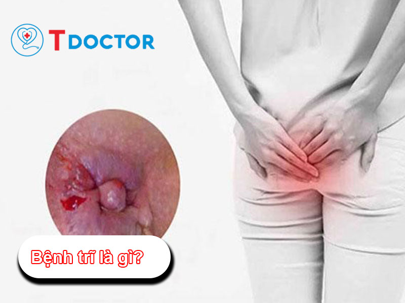 Bệnh trĩ: Nguyên nhân, dấu hiệu và cách điều trị hiệu quả Bệnh trĩ: Nguyên nhân, dấu hiệu và cách điều trị hiệu quả