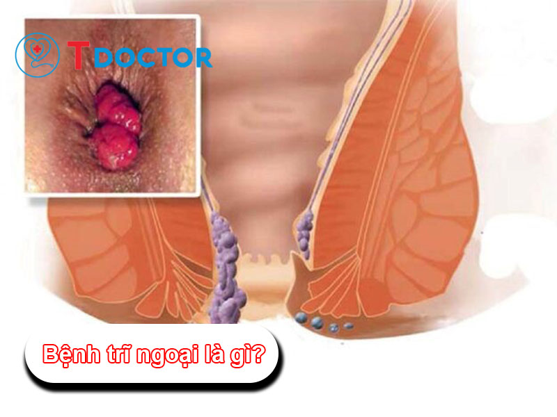 Bệnh trĩ ngoại là gì? Nguyên nhân và cách điều trị An Toàn Bệnh trĩ ngoại là gì? Nguyên nhân và cách điều trị An Toàn