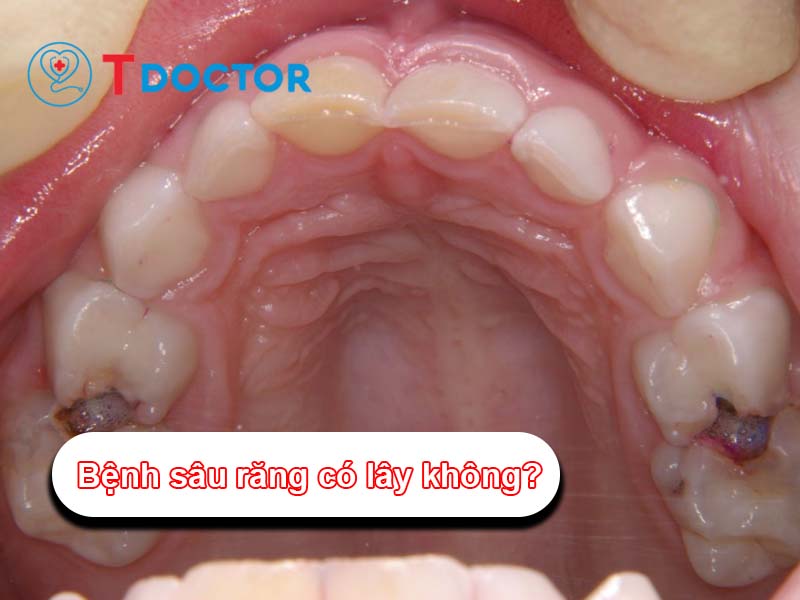 Bệnh sâu răng có lây không? và cách phòng tránh hiệu quả Bệnh sâu răng có lây không? và cách phòng tránh hiệu quả