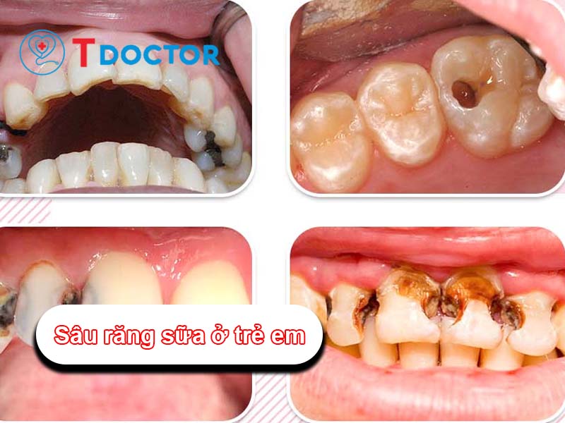 Sâu răng sữa: Nguyên nhân và cách khắc phục tình trạng này Sâu răng sữa: Nguyên nhân và cách khắc phục tình trạng này