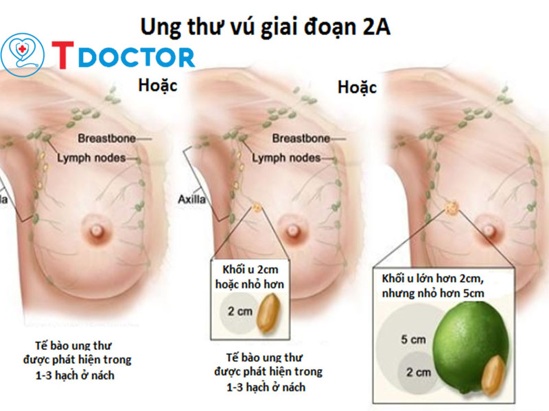Ung thư vú giai đoạn 2: Dấu hiệu, điều trị và chế độ ăn uống 