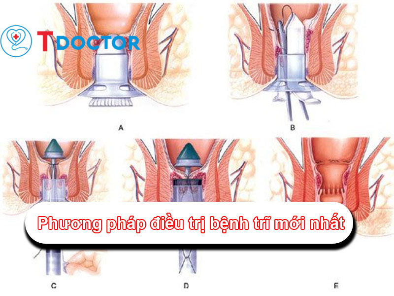 Tổng hợp các phương pháp điều trị bệnh trĩ mới nhất