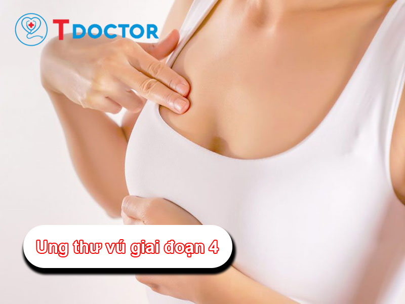 Ung thư vú giai đoạn 4 là gì? Những triệu chứng thường gặp
