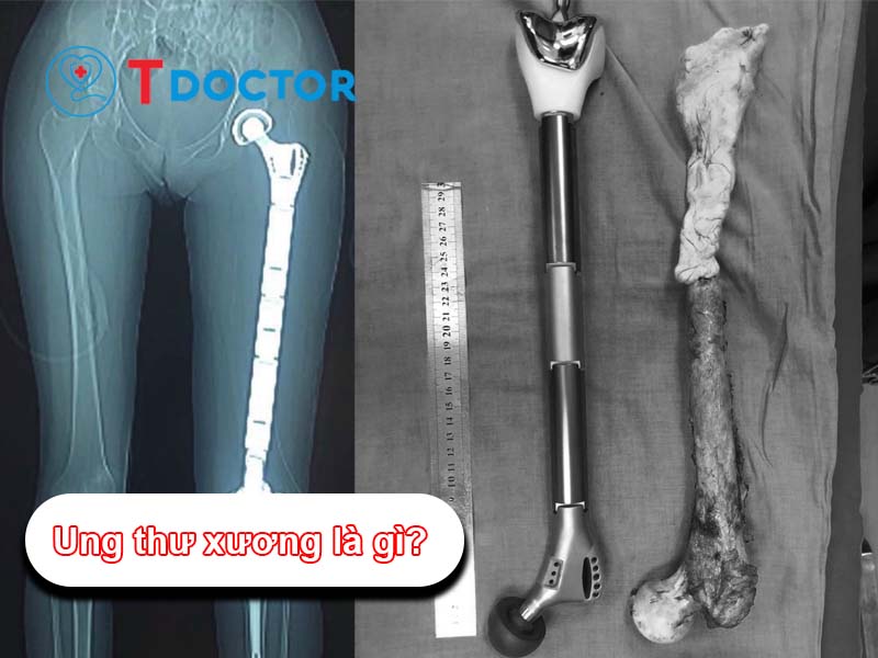 Ung thư xương: Nhận dạng, Triệu chứng và các yếu tố nguy cơ