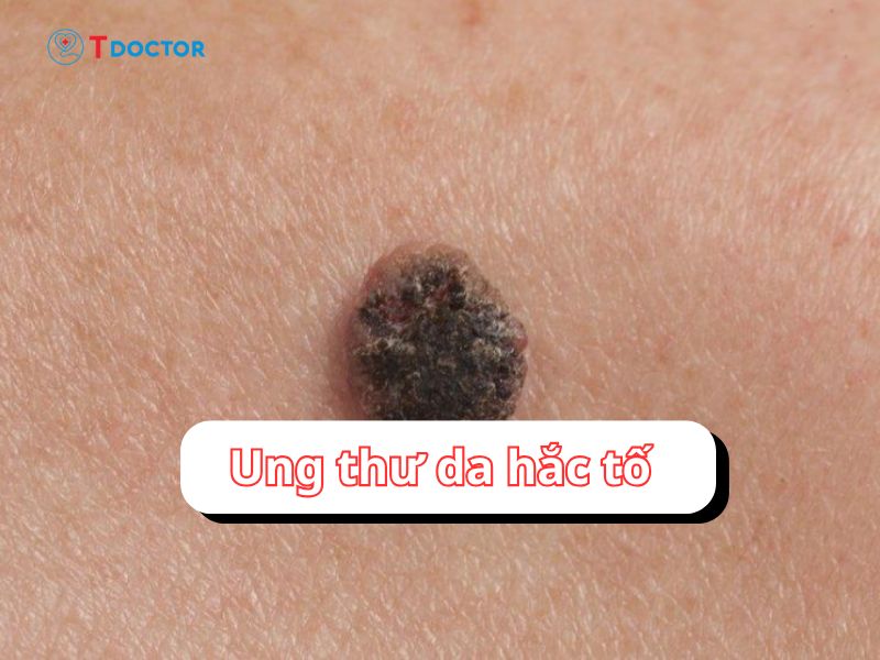 Ung thư da hắc tố: loại ung thư da nguy hiểm nhất