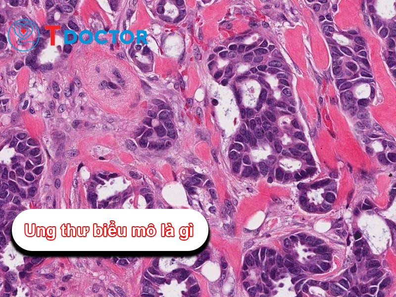 Ung thư biểu mô là gì? Có các loại ung thư biểu mô nào?