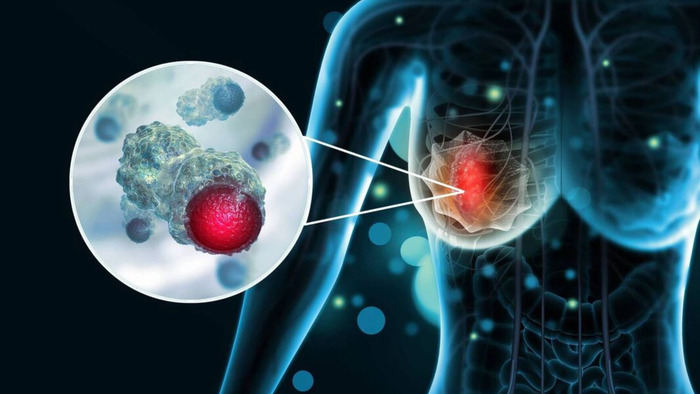 Ung Thư Vú Và Tuyến Giáp: Nguyên Nhân, Cách Điều Trị Và Thuốc Hỗ Trợ Chính Hãng